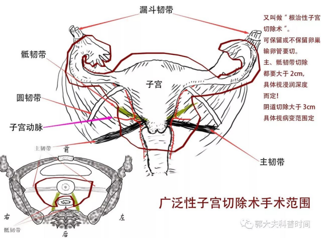 关于子宫切除全解读之——切除范围