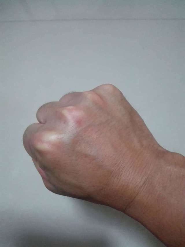 桡骨远端骨折手法复位及康复注意事项