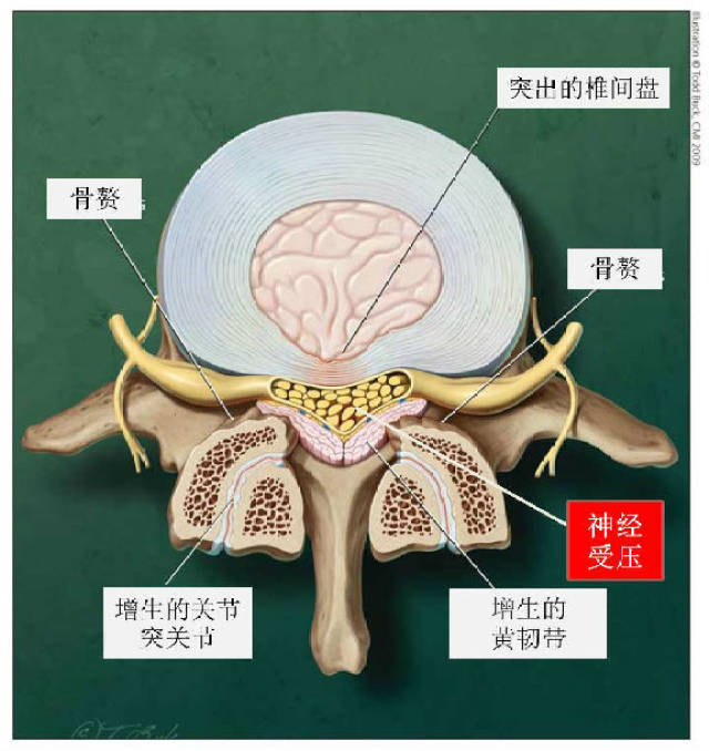 腰椎管狭窄症的微创手术治疗