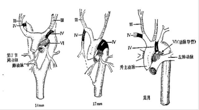 医学科普:主动脉弓部发育及变异