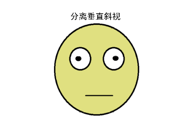 动画展示20多种常见斜视眼位特点,过目不忘!