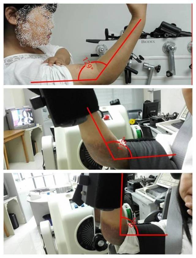 功能障碍康复方法之肌肉牵伸技术