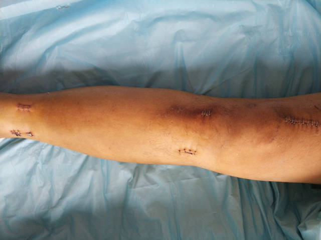 患者男性,高处坠落伤小腿,经过髌上入路髓内钉微创治疗 手术前照片