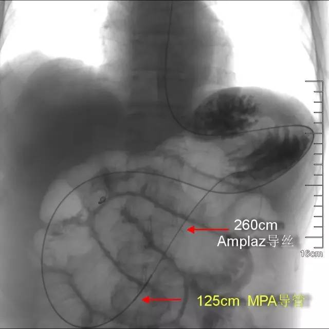 治疗肠梗阻新方法:专用肠梗阻导管置入