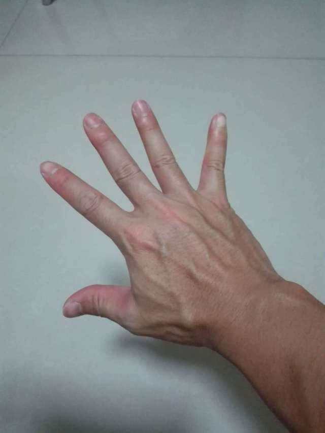 桡骨远端骨折手法复位及康复注意事项