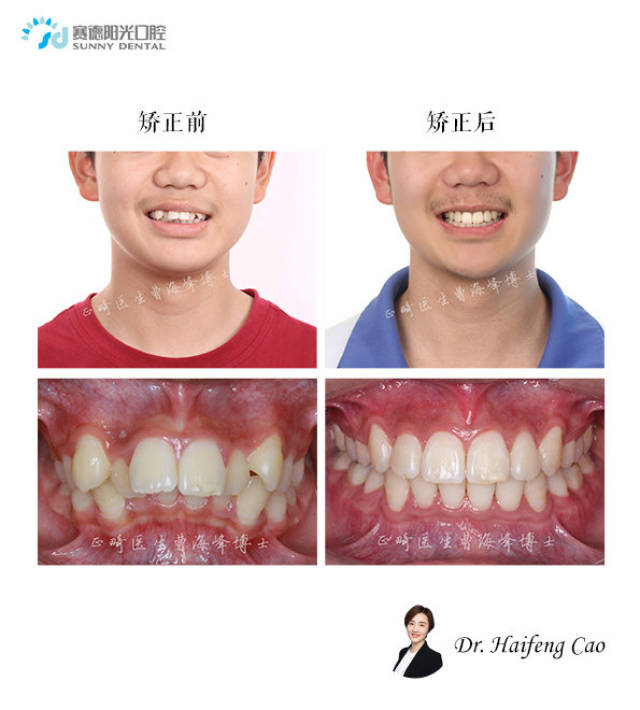 【早期矫正:下颌后缩,纠正"小鸟嘴"】