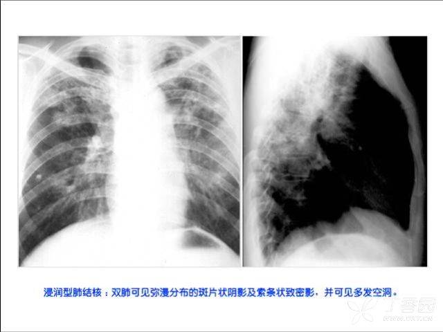 照片名称:液气胸