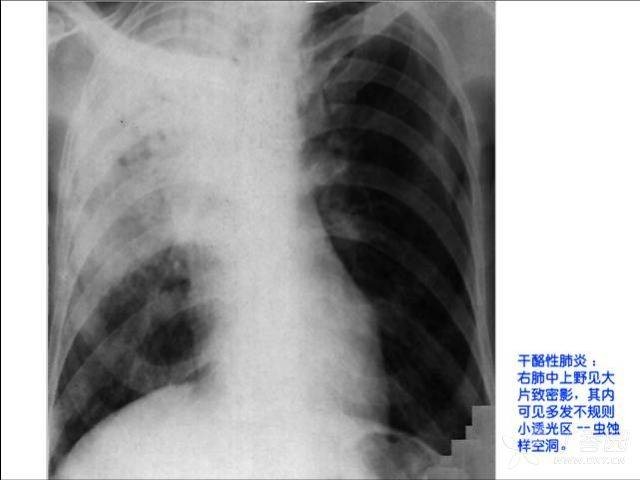 照片名称:急性粟粒型肺结核