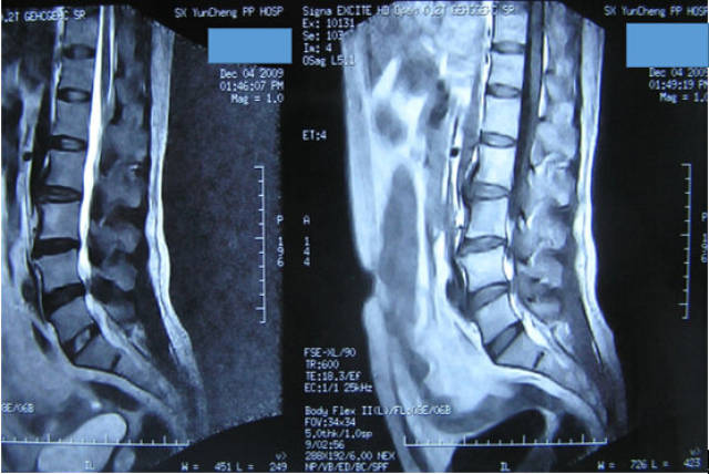 腰椎mri显示腰4-5椎间盘突出及椎管狭窄.