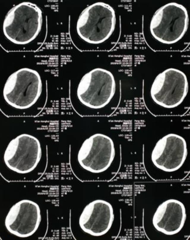 患者头部ct提示右颞顶硬膜外血肿,量约90ml
