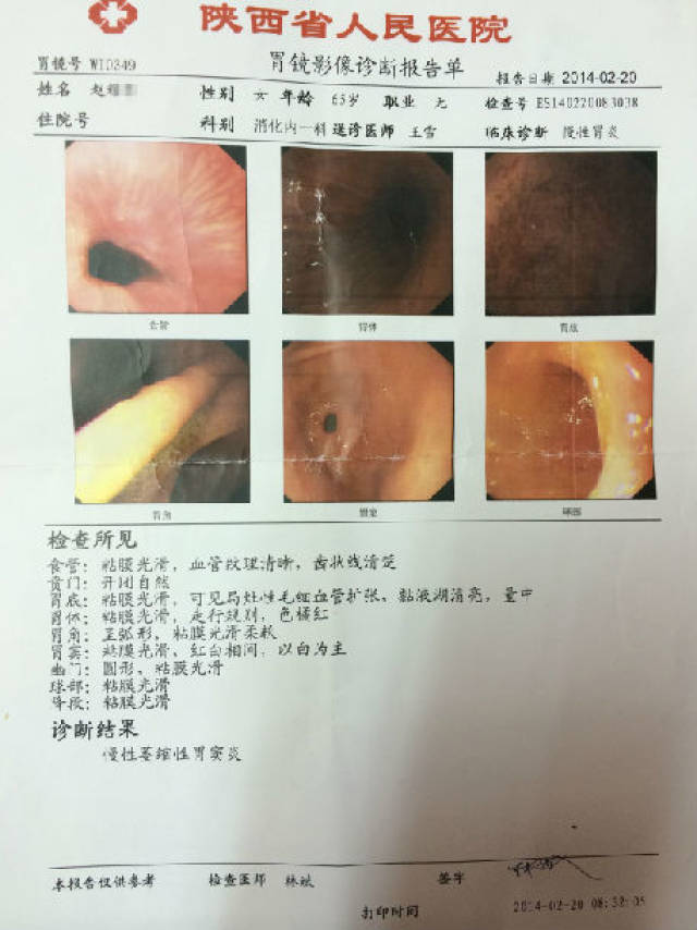 疗后胃镜报告