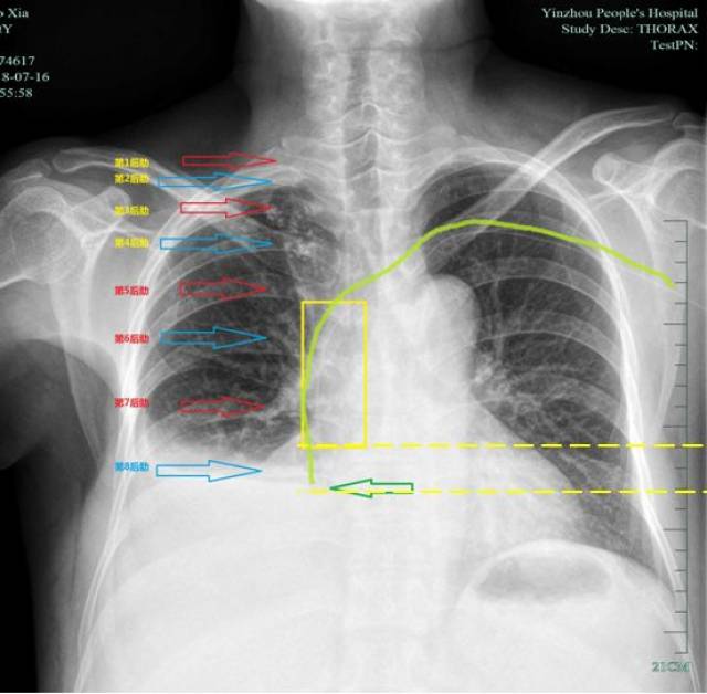 图2picc胸片标识图