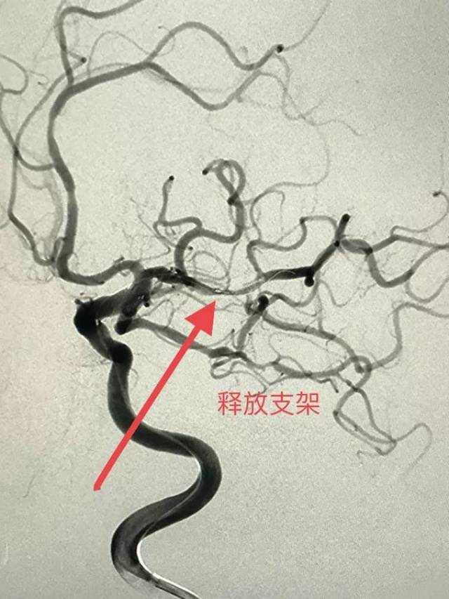 熬夜打牌突发脑梗,介入支架护佑平安