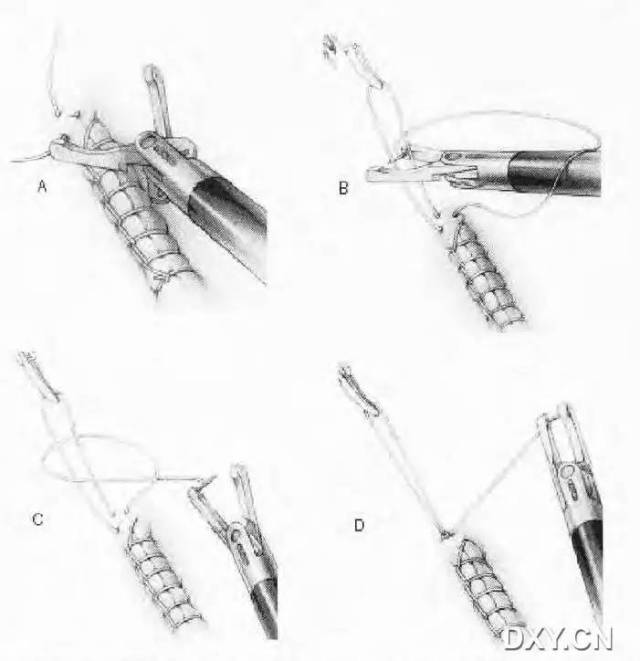 腹腔镜下缝合与打结 (转载)