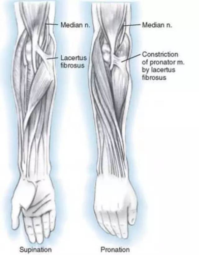 旋前圆肌综合征 当前臂旋转时,旋前圆肌肱二头肌腱膜可压迫正中神经.