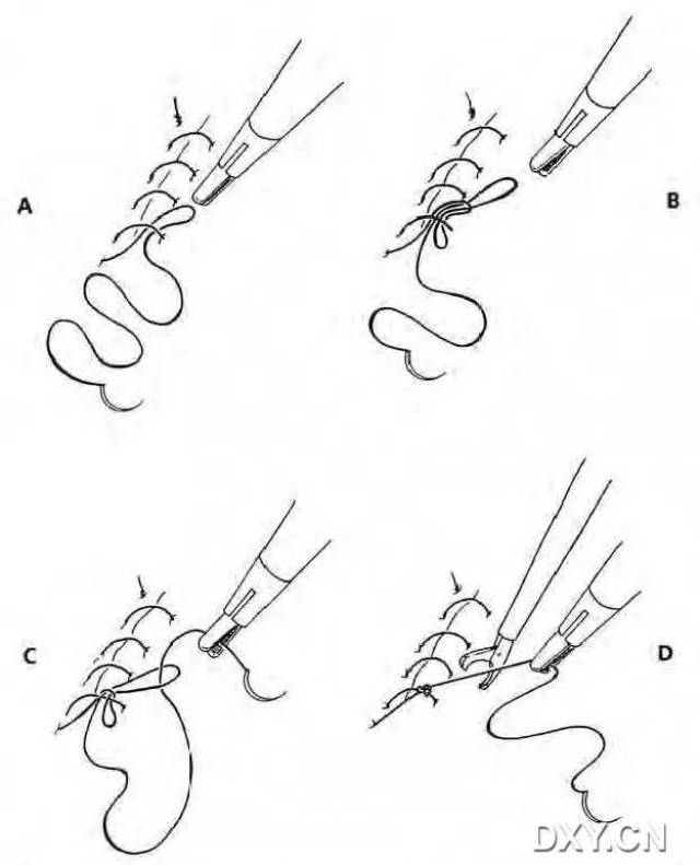 腹腔镜下缝合与打结 (转载)