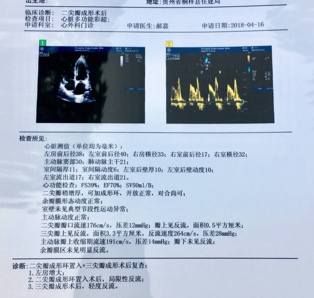 瓣膜退行性变病理解剖改变为二尖瓣前叶或后叶腱索延长或断裂导致图片