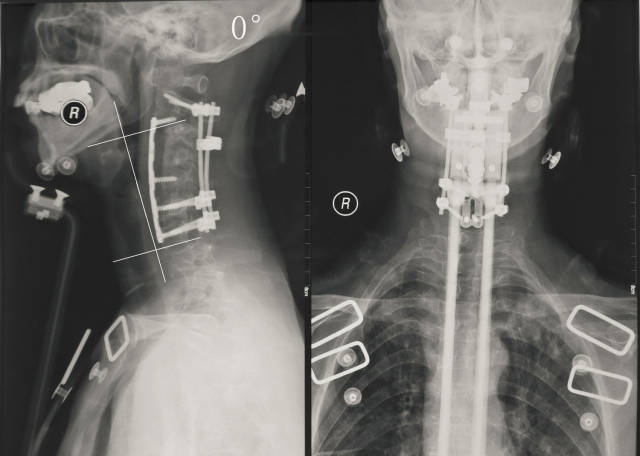 陈旧性脊柱结核后凸畸形和脊柱结核手术失败后凸畸形手术治疗.