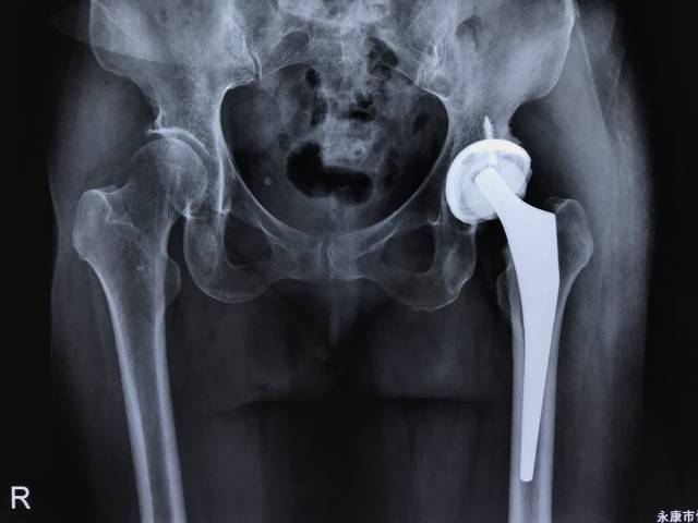 髋关节骨性关节炎合并股骨头坏死人工全髋置换病例