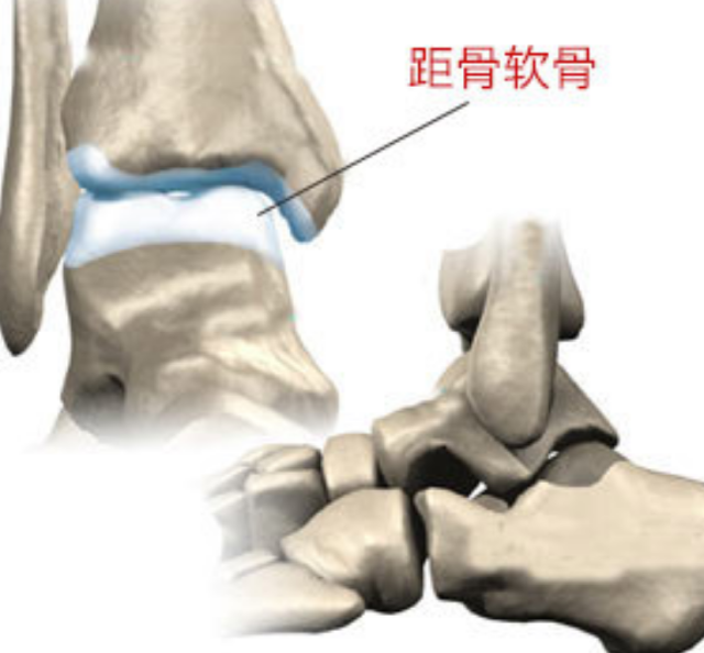 距骨软骨损伤是怎么回事?