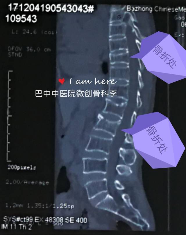多节段胸腰椎骨折微创pkp手术