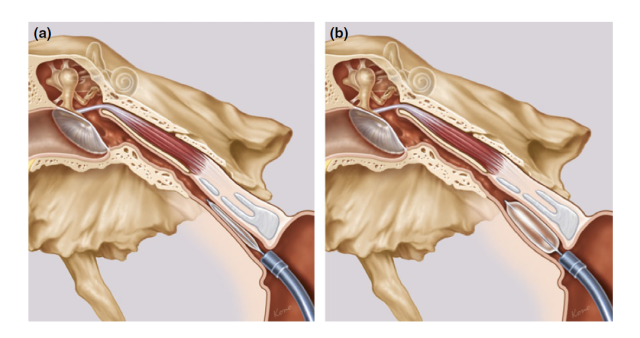 咽鼓管球囊扩张术 ——难治性分泌性中耳炎患者的福音