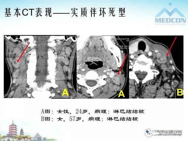 颈部淋巴结结核msct表现及鉴别 | 影像天地