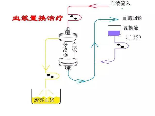 一,经典王牌:血浆置换