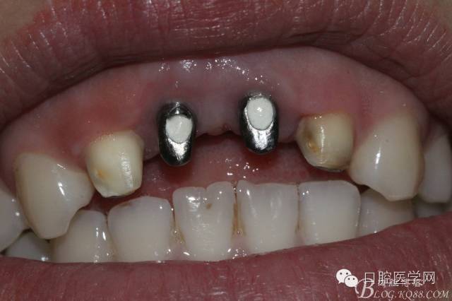 该患者因两颗中切齿缺失太久,侧切不美观,12.22桩冠修复.