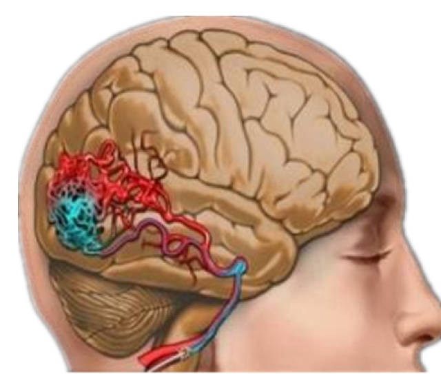 得了脑血管畸形可以不治疗吗?