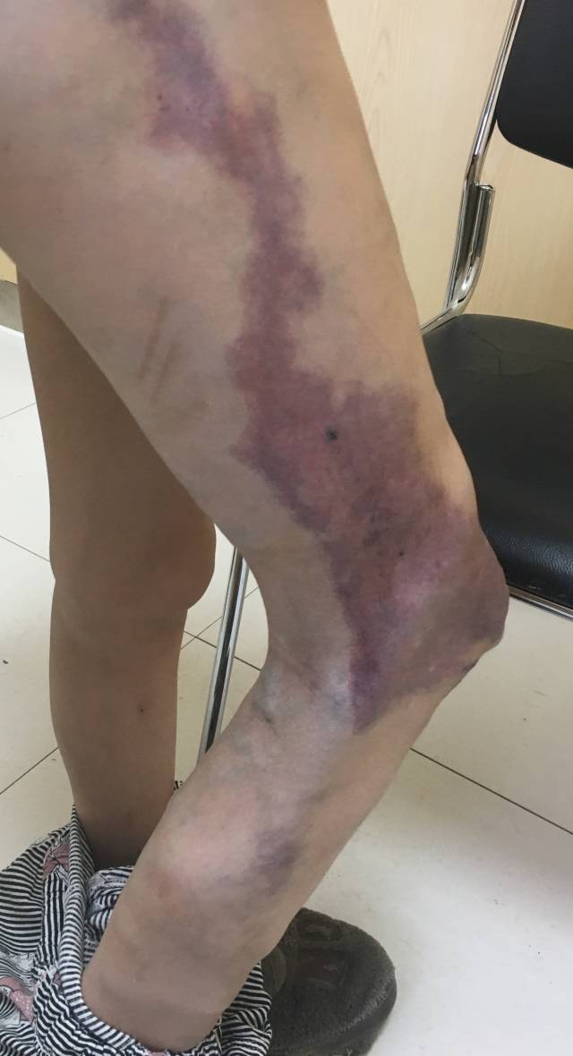 无水乙醇,聚桂醇,聚多卡醇治疗血管畸形,静脉畸形,血管瘤.