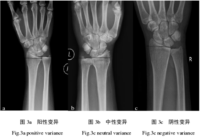 手腕部疼痛,需谨防尺骨撞击综合征