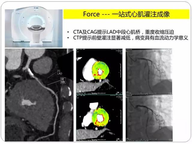 dsa图像前降支中段心肌桥具有显著收缩压迫