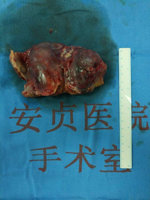 右心房血管肉瘤一例