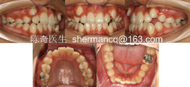 4,"虎牙"(尖牙错位) 治疗前牙齿咬合