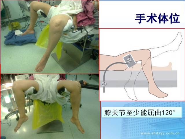 膝关节内侧单髁置换