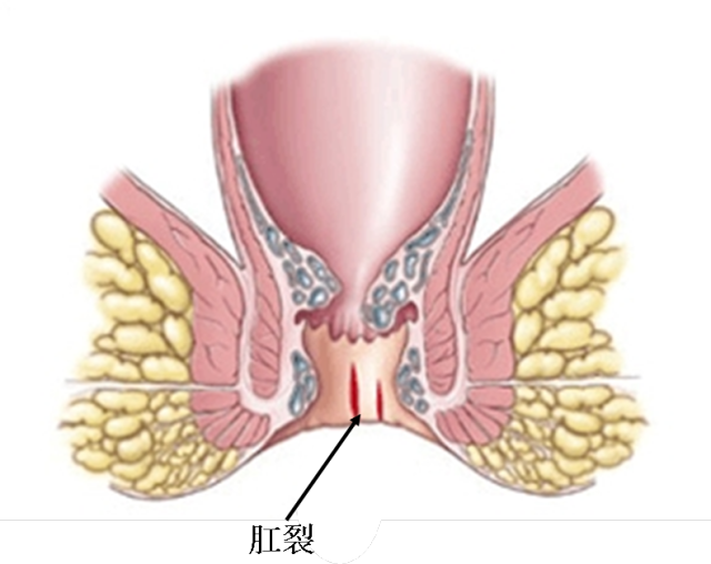 肛周不适必读文章---肿块,疼痛,便血和瘙痒