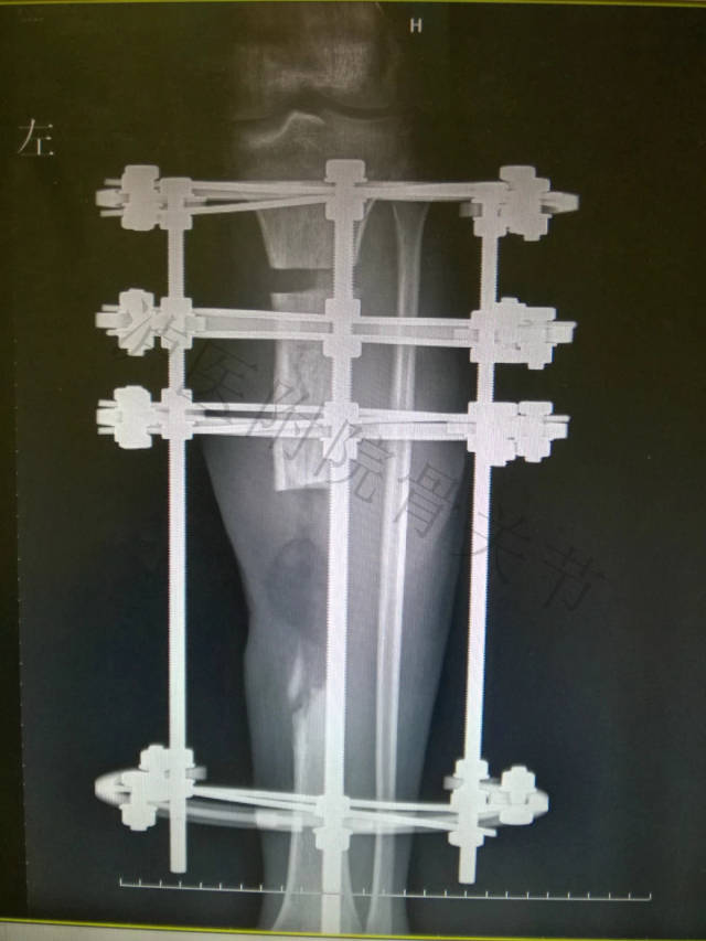 骨搬运术治疗长节段感染性骨不连