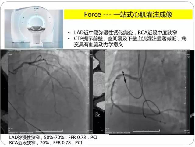 双源ct心脏成像最新应用与进展—专家解读(三)
