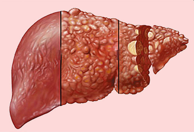这3个皮肤症状是肝癌给你的最后通知