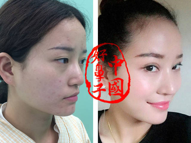 隆鼻:设计鼻翼沟, 气质苦逼的灵动表情