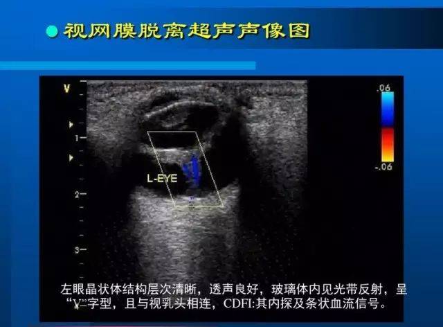 眼部b超常见病的图像及诊断