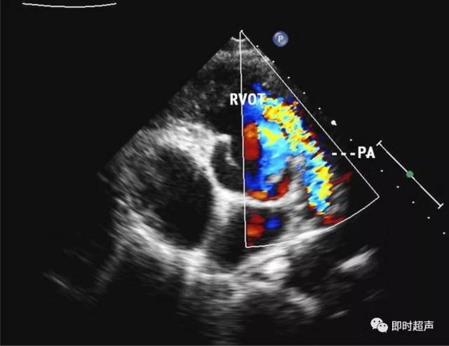 法洛四联症的超声诊断