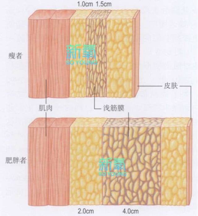 其实胖的人和瘦的人皮下组织中的肌肉部分以及浅层脂肪组织的厚度是差