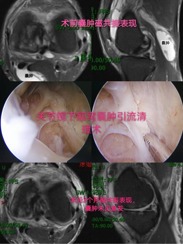 清理腓肠肌内侧头与半膜肌腱间的单向"阀门"筋膜,更应彻底清理囊肿璧