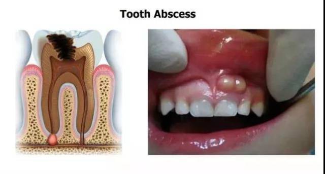 牙龈出现白脓包,你以为只是发炎吗?