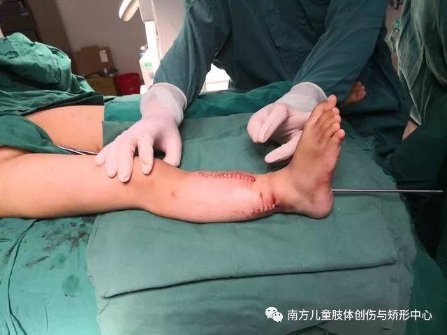 先天性胫骨假关节病例分享