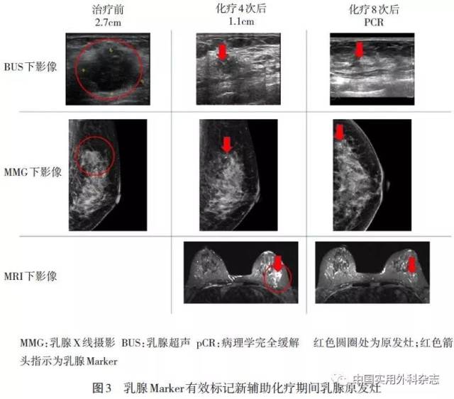 专题笔谈|可视化经皮穿刺乳腺病灶定位标记夹的临床应用