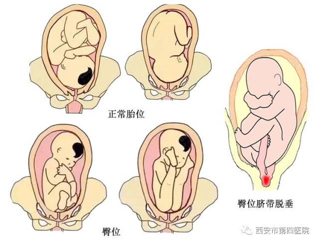 臀位约占足月分娩总数的3%～4