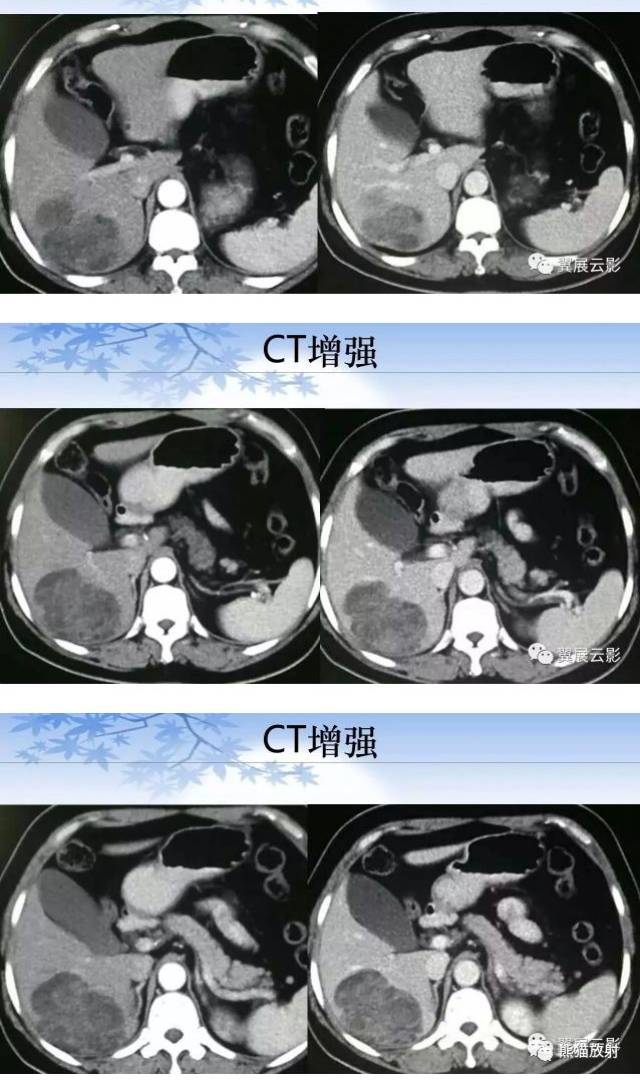 含脂肝细胞肝癌丨影像表现和鉴别诊断